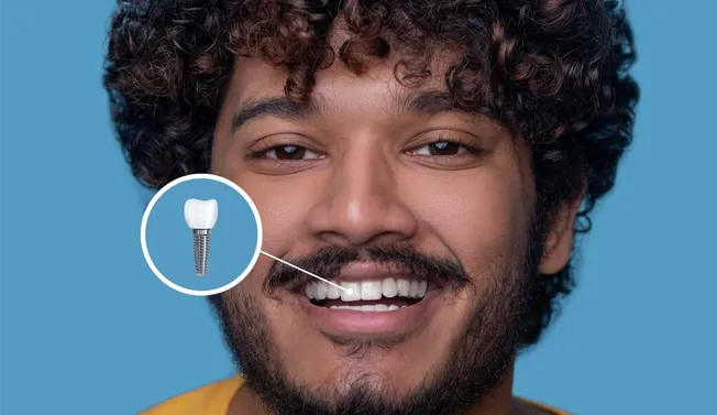 Dental Implant Placement